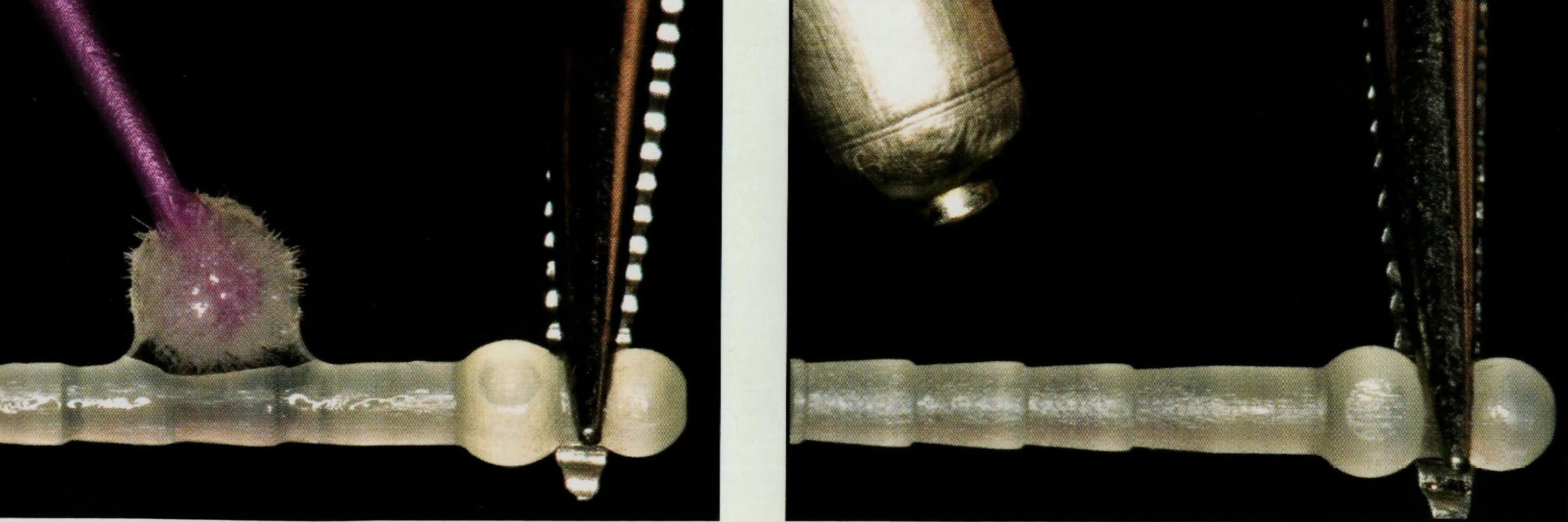 How to cement a fiber post ? Dental Esthetics