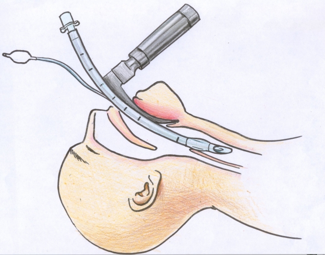 Intubation procedure Video MedchromeTube