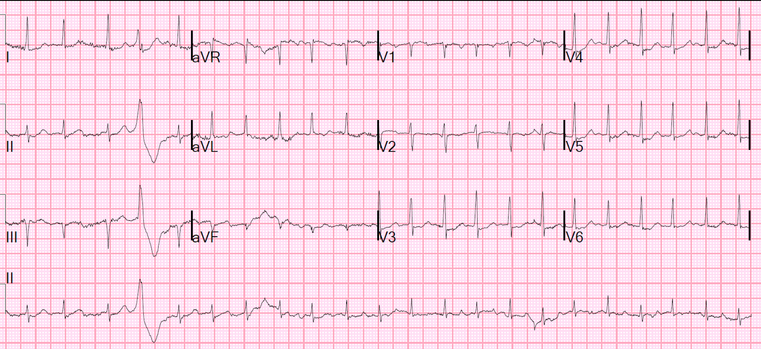 Atrial fibrillation paroxysmal Electrocardiogram Prediction