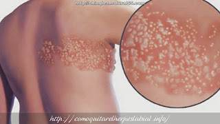 Como curar herpes zóster rápido