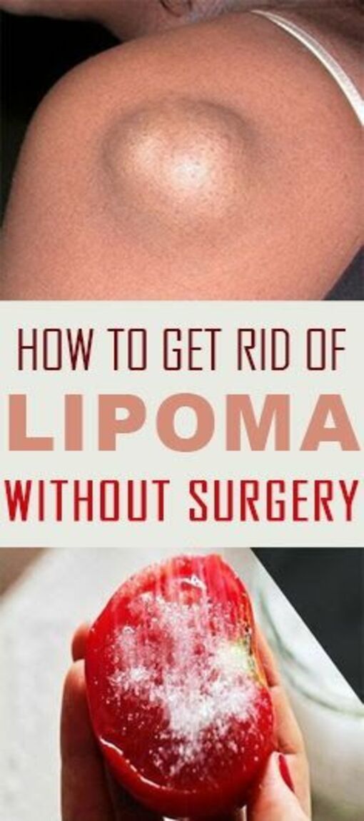 How To Get Rid Of Lipoma Without Surgery? Healthy Longue 201