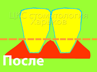 Состояние межзубных промежутков и контура десны после ортодонтического лечения Схема образования черных треугольников