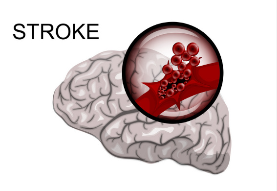 Stroke