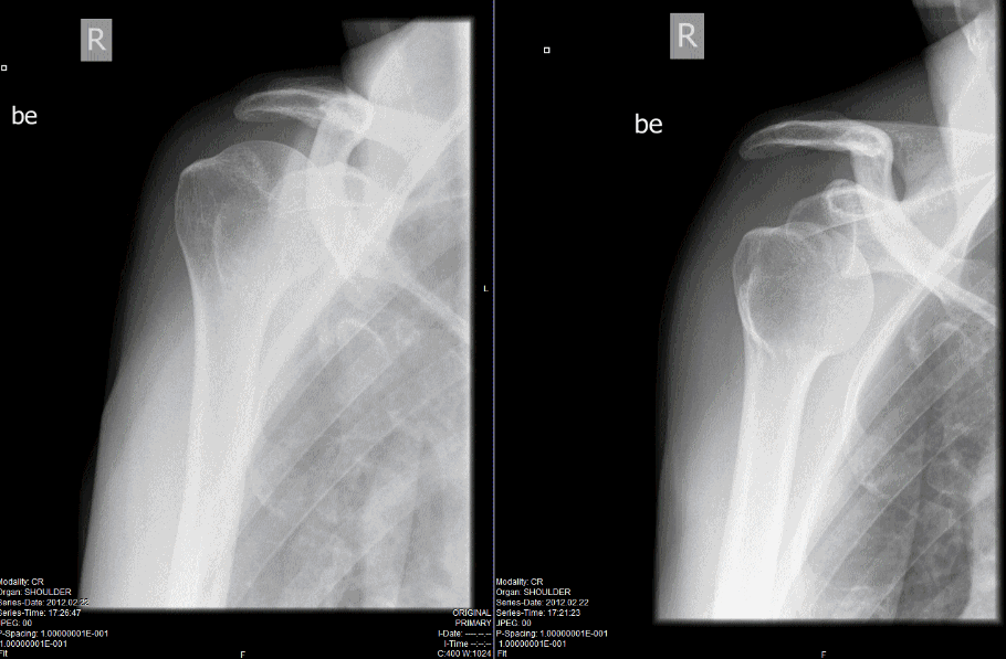 When a tweet isn't long enough Dislocated Shoulder (or how not to Ski)