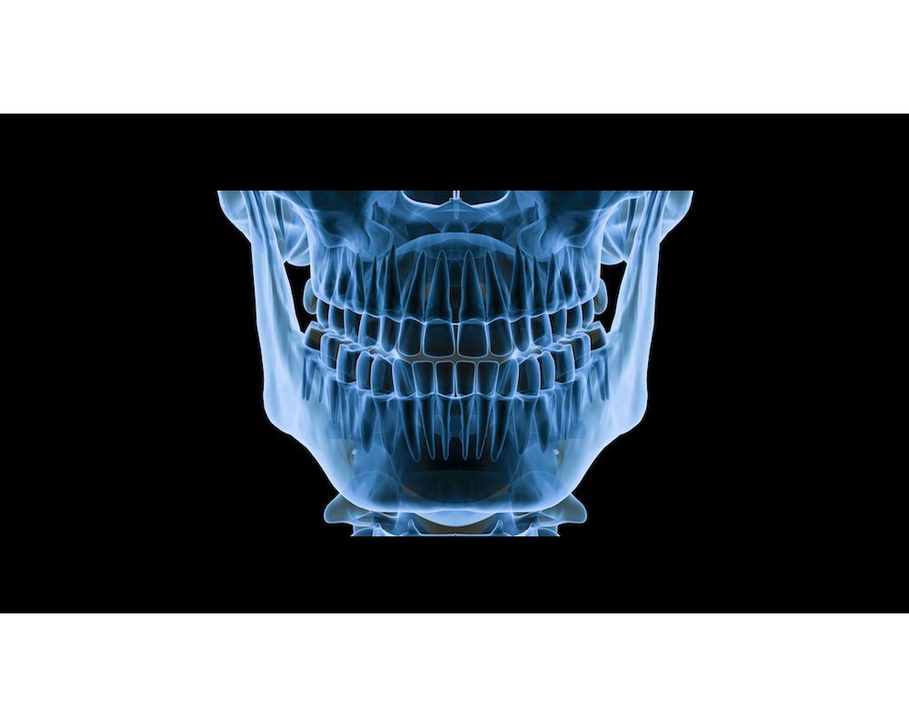 Do you need x ray for braces? Why? OdontoVida