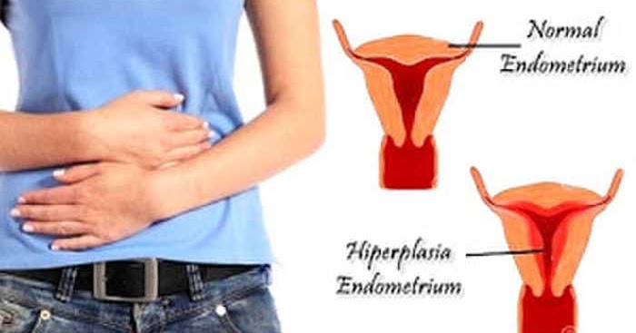 Inilah Penyebab Penebalan Dinding Rahim Yang Jarang Diketahui Rhodoy R Ediyansyah