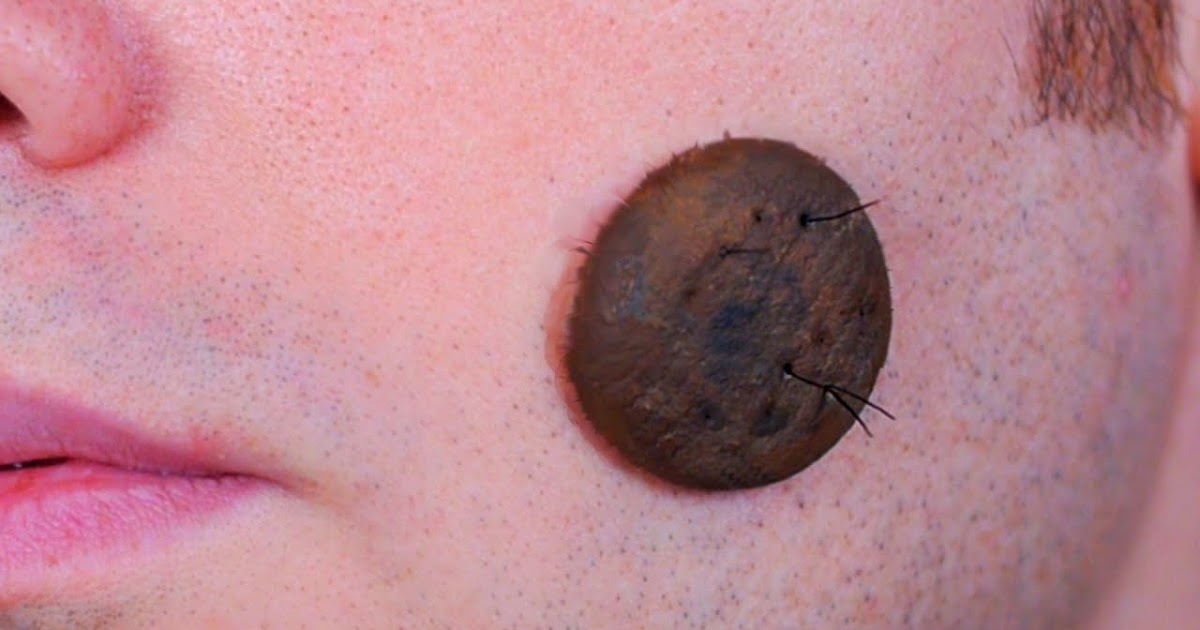 What Your Mole Tells About You According To Filipino Superstition Ify Books