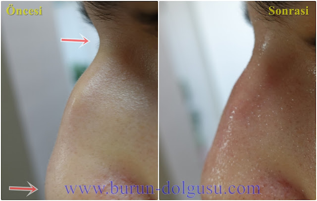 Burun Kökü Dolgusu - Burun Dolgusu - Dolguyla Burun estetiği - Non-surgical Nose Job In Istanbul - Dolgu İle Burun Ucu Kaldırma - Burun Ucu Dolgusu - Burun Dolgusu Fiyatı - Ameliyatsız Burun Estetiği - Burun Dolgusu Fiyatları - Dolgu İle Burun Kaldırma - Dolgu İle Burun Düzeltme