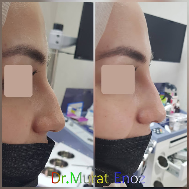 Non-surgical rhinoplasty with filler istanbul