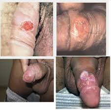 Sipilis