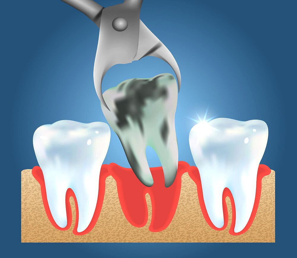Tudo o que você precisa saber sobre extração dentária OdontoVida