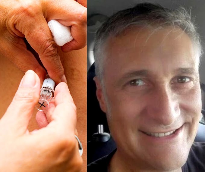 Dentista italiano antivacuna que usó brazo de silicona para evitar la dosis, recibió la vacuna y asegura es la mejor arma contra el Covid