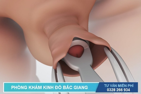 Cắt bao quy đầu ở Bắc Giang 