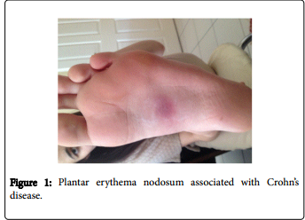 Journals and Conferences on Gastroenterology: Plantar Erythema Nodosum ...