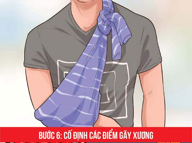 co-dinh-cac-diem-gay-xuong