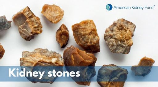 حصوات الكلى والحالب والمثانة: دليل للأسباب والأعراض والعلاج