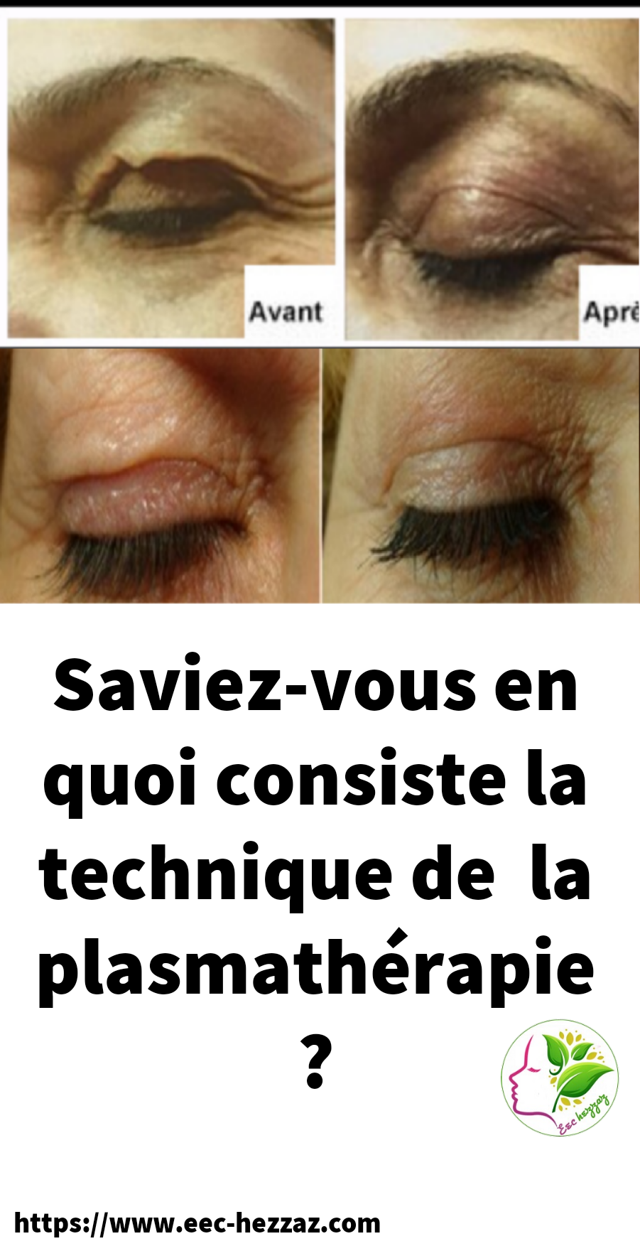 Saviez-vous en quoi consiste la technique de  la plasmathérapie ?