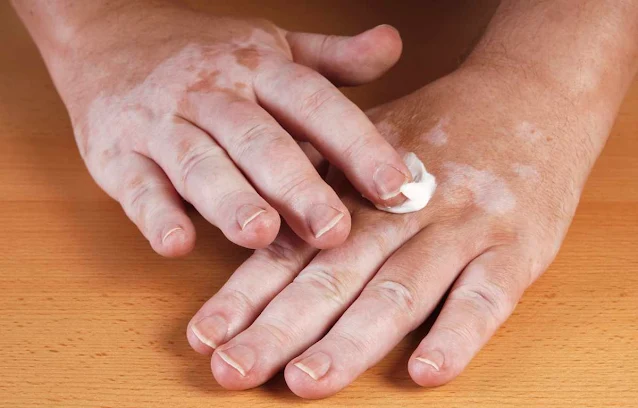 crema efectiva para revertir los efectos del vitiligo