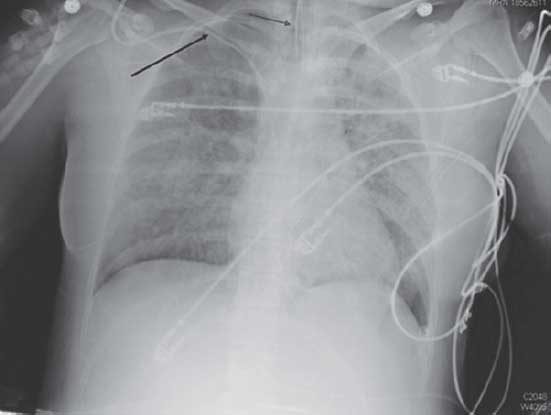 CXR showing diffuse bilateral alveolar opacities consistent with ARDS