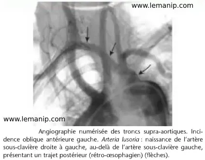 Indication est Utilisations De L'angiographie Cérébrale