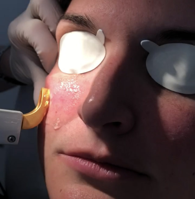 Review (with pictures) Excel V Laser for rosacea treatment and facial