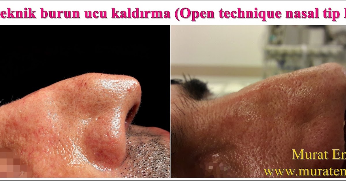 Açık Teknik Burun Ucu Kaldırma (Open Technique Nasal Tip Lifting)