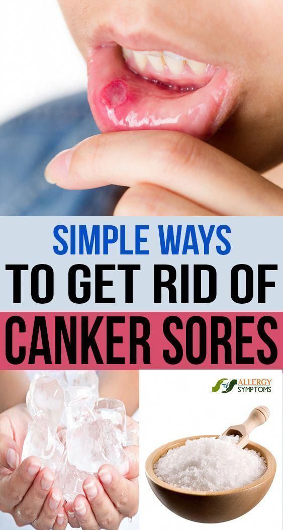 simple-to-get-rid-of-canker-sores-precious-health
