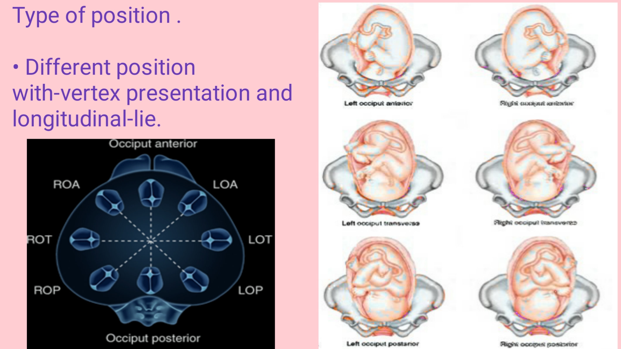 fetus in vertex presentation and longitudinal lie