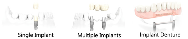 Treatment option of dental implant