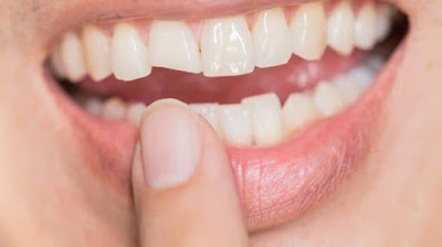 Răng bị mẻ thì phải làm sao?