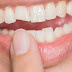 Khắc phục răng mẻ an toàn và hiệu quả