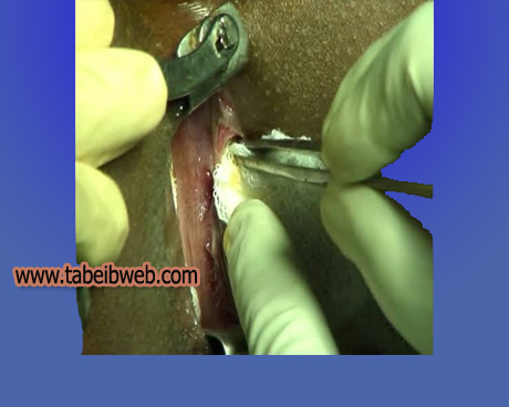 عملية جراحة الشرخ الشرجى بالصور Anal Fissure Surgery طبيب ويب
