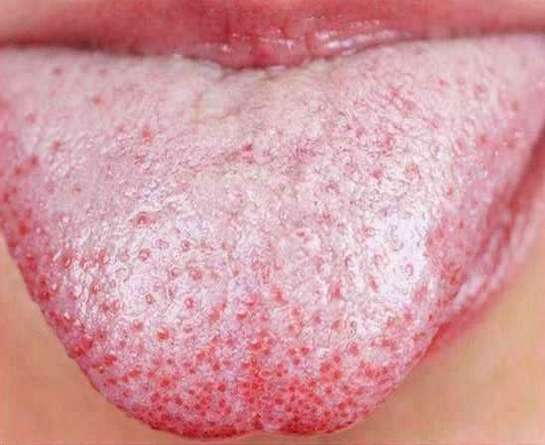 Picture Of Oral Thrush 120