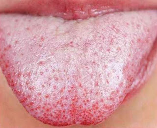 Oral Thrush In Adults : Treatment, Symptoms and Prevention