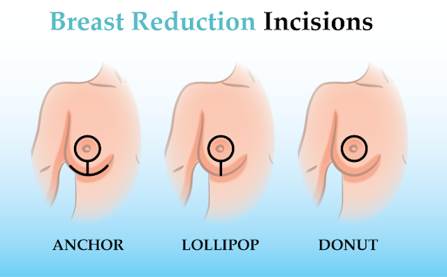 breast-reduction-incisions