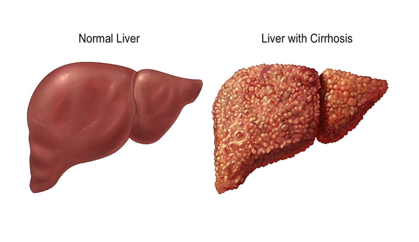 Fatty Liver. HEALTH INFORMATION