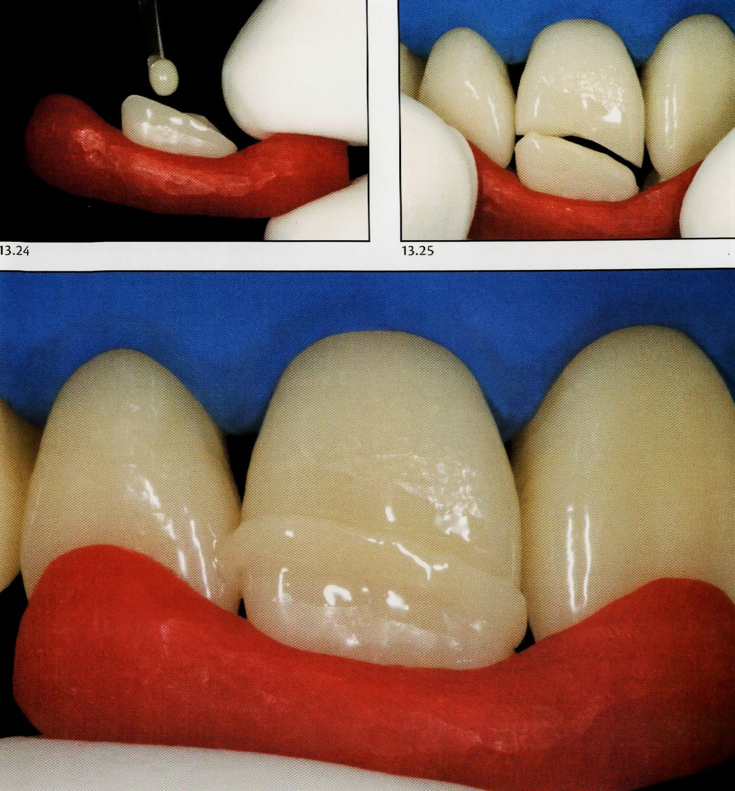 Tooth fragment reattachment Dental Esthetics