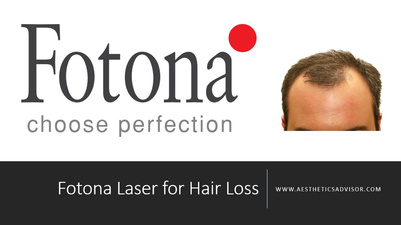 Fotona Laser to treat Hair Loss The Exact Protocol to bring a 52year