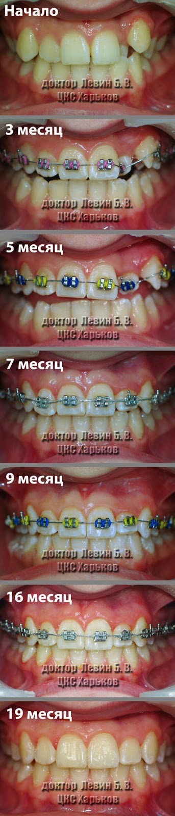 Эволюция ортодонтического лечения серия фотографий отражающая этапы ортодонтического лечения на протяжении 19 месяцев