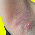 Lumps In Armpit what is it ?