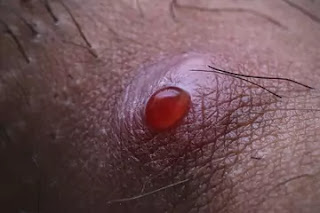 Scalp Folliculitis Treatment Scalp Folliculitis Treatment