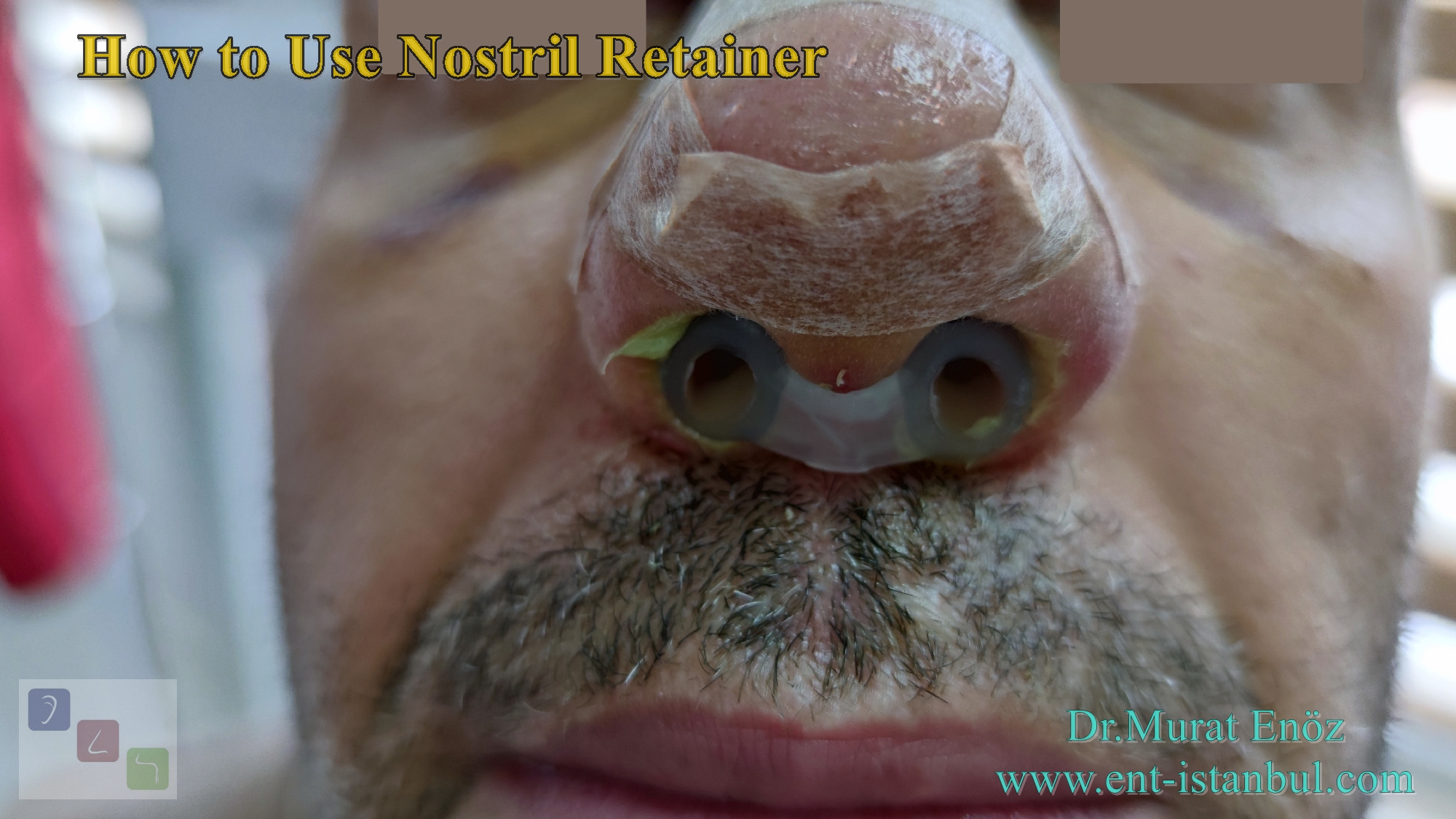 About The Nostril Retainer
