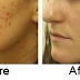 How To Lighten and Remove Old Scars From Legs And Face At Home
