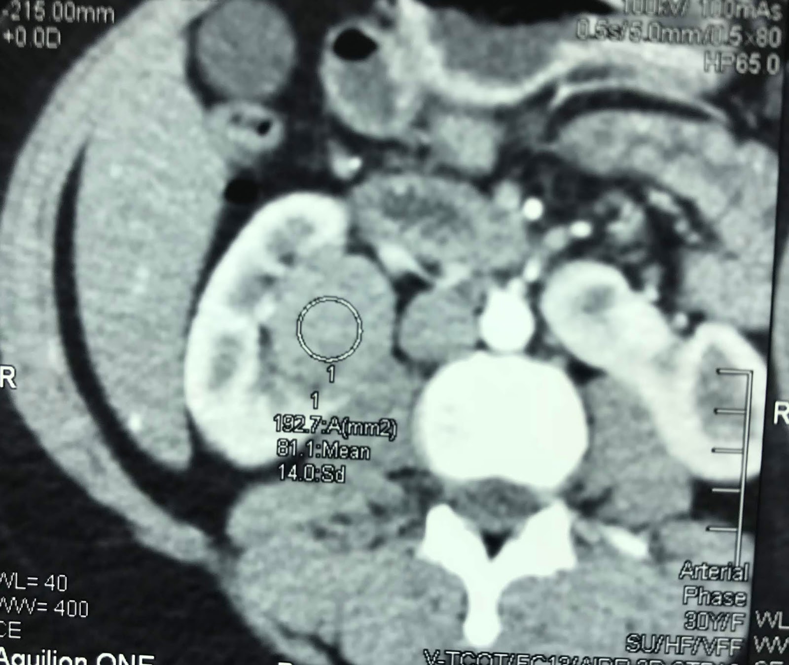 VIETNAMESE MEDIC ULTRASOUND CASE 560 TUMOR IN HORSESHOE KIDNEY, Dr
