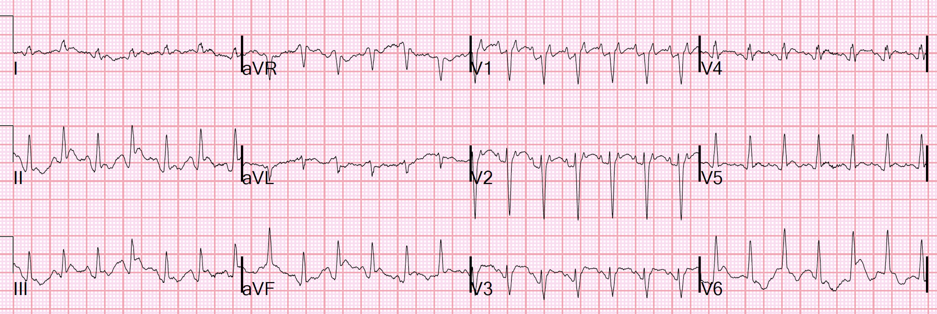 Dr. Smith's ECG Blog Prehospital Cath Lab Activation for inferior