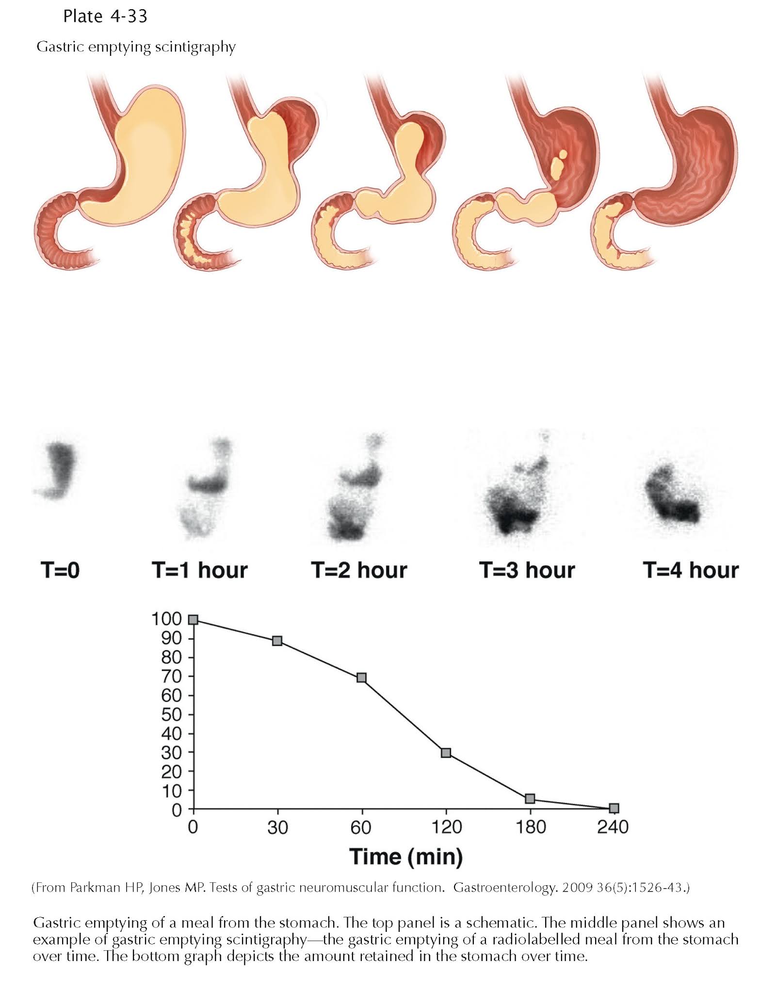 DIAGNOSTIC AIDS IN GASTRIC DISORDERS GASTRIC EMPTYING SCINTIGRAPHY