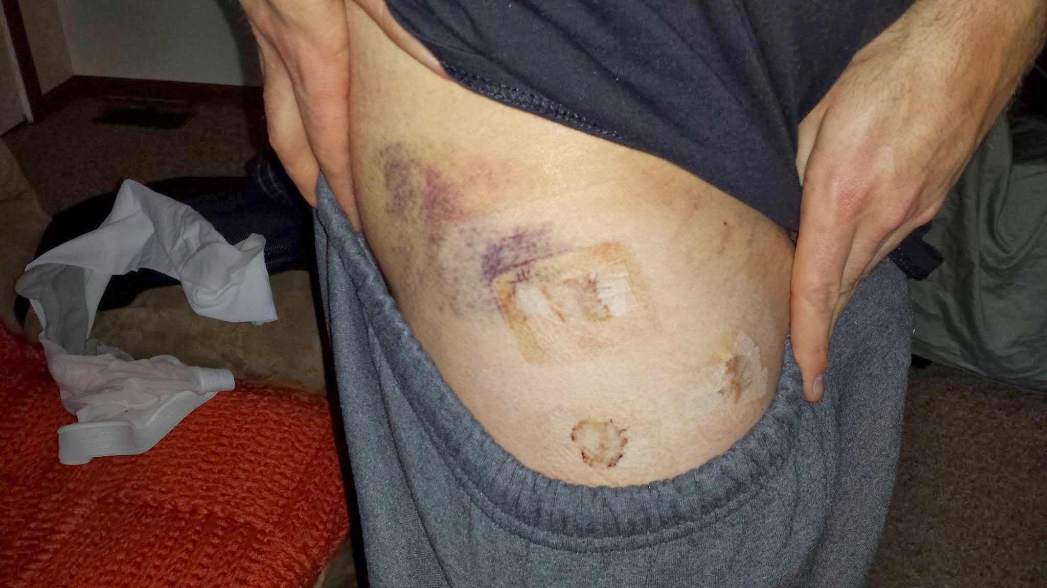 FAI *Femoroacetabular Impingement* Arthroscopic Hip