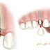 تعرف على مزايا وعيوب زراعة الأسنان