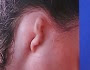 Sude''nin Yeni Kulağı, Kaburga Kıkırdağından Sude'ye Kulak Ameliyatı