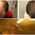 Baldness Treatment Recipe, After Two Days Your Hair Will Begin To Grow